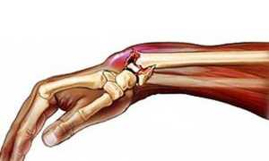 Растяжение связок мышц руки симптомы и лечение