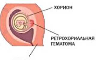Ретрохориальная гематома