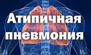 Атипичная пневмония — в чём отличие? Симптомы и лечение