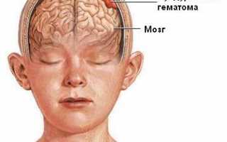 Гематома головного мозга — симптомы и лечение